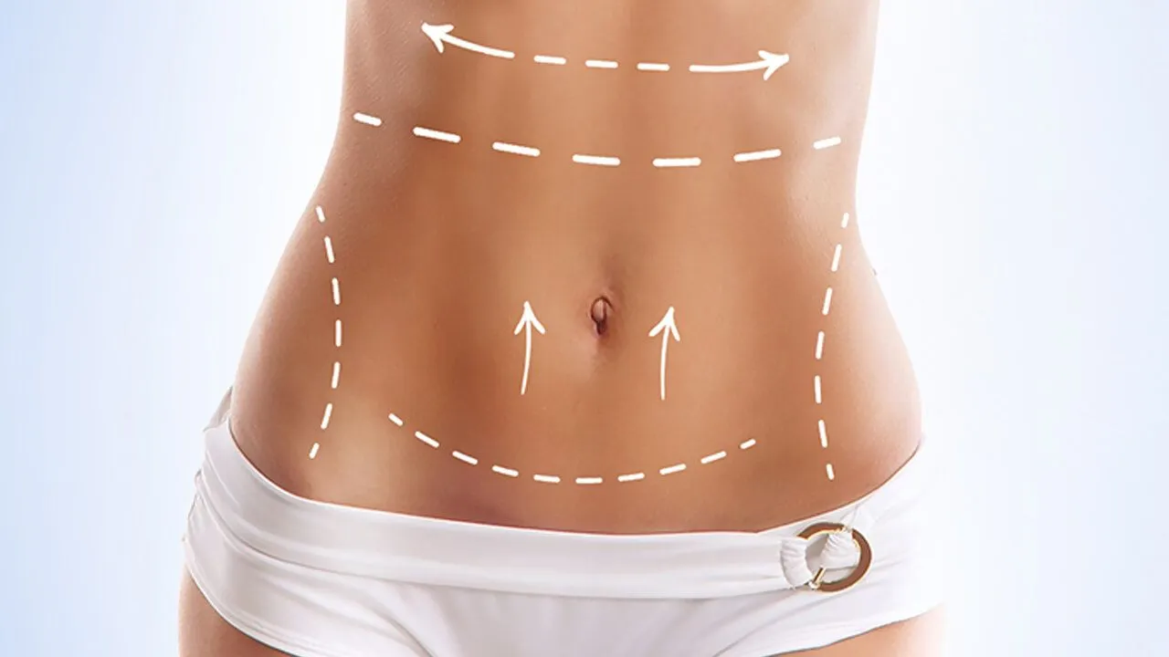 L'abdominoplastie et la plastie abdominale