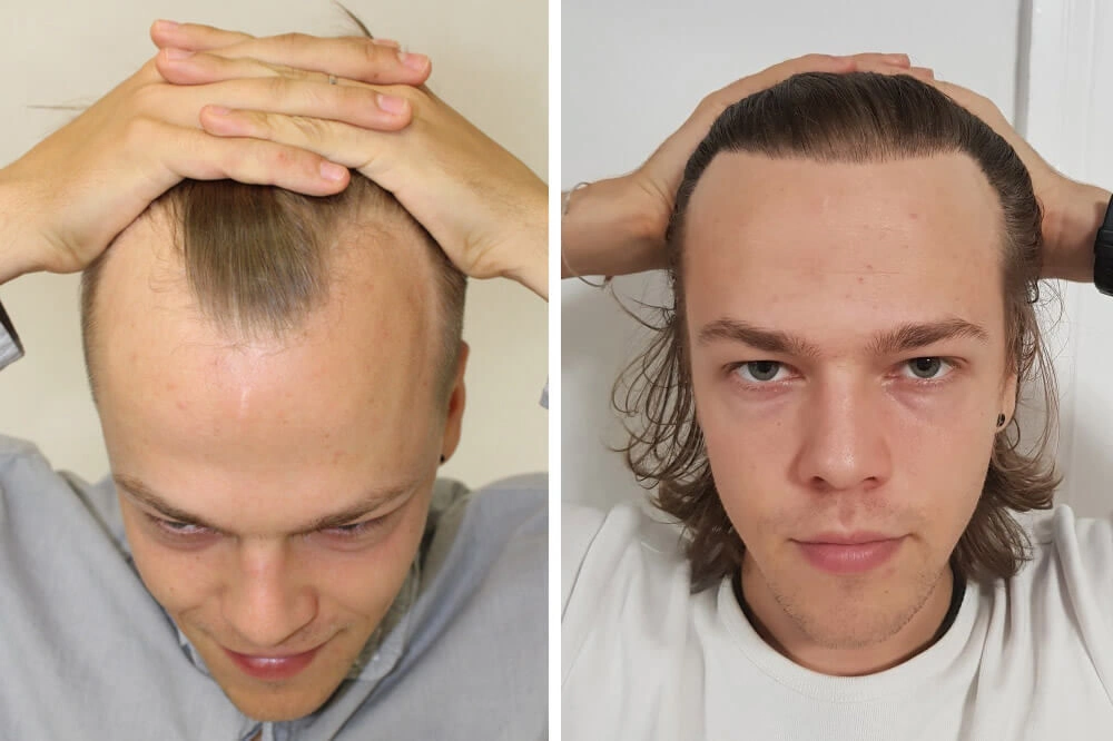 2 Weeks After FUE Hair Transplant