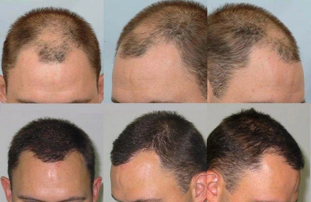 3 Months After Hair Transplant