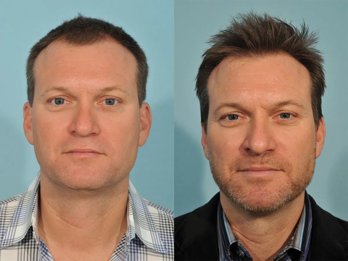 5000 grafts hair transplant