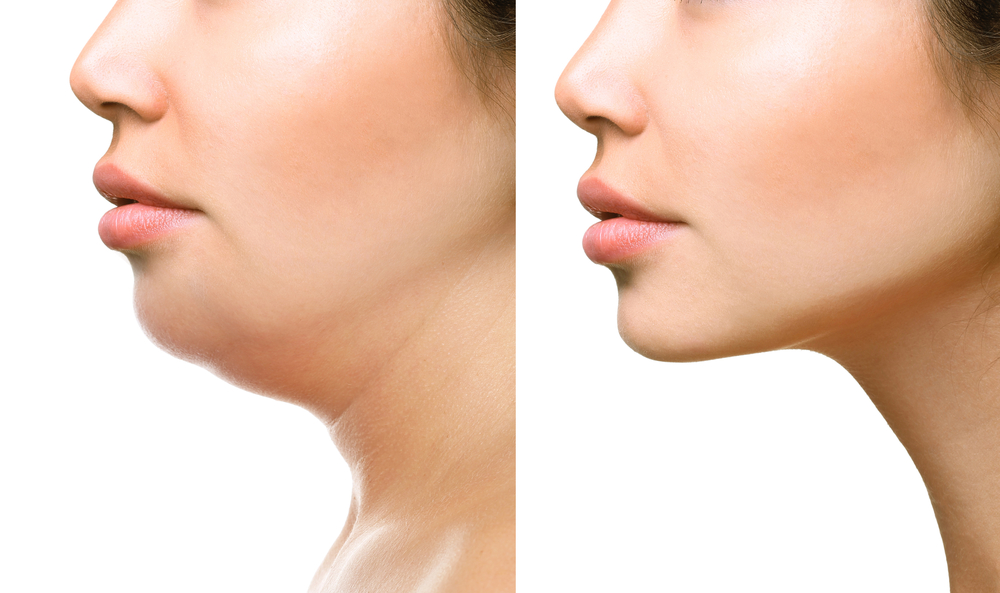 We'll explore liposuction for face, delving into the details of the procedure, its benefits, and how it compares to other techniques.