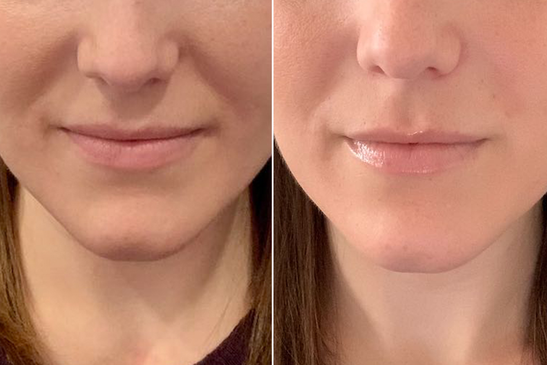 The nasolabial folds, also known as the smile line or laugh line, is a prominent facial feature that can impact your appearance.