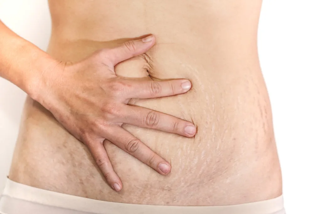Non-Surgical Belly Fat Reduction in Turkey