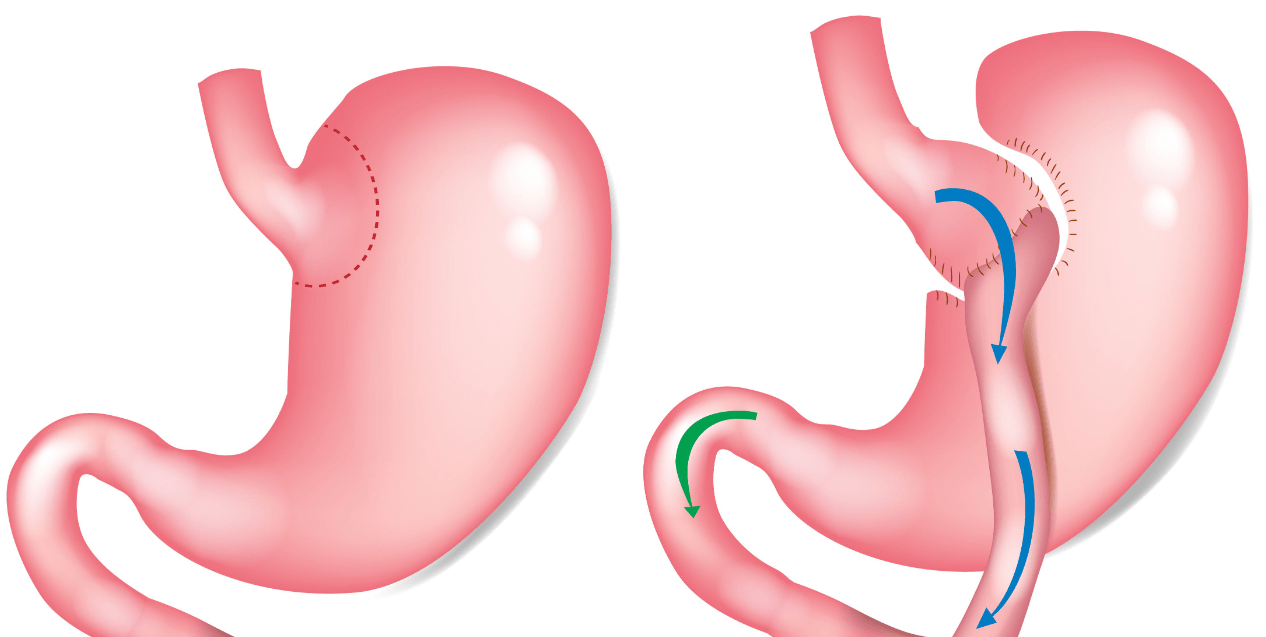 Weight Loss Surgery Abroad - Gastric Sleeve & Bypass