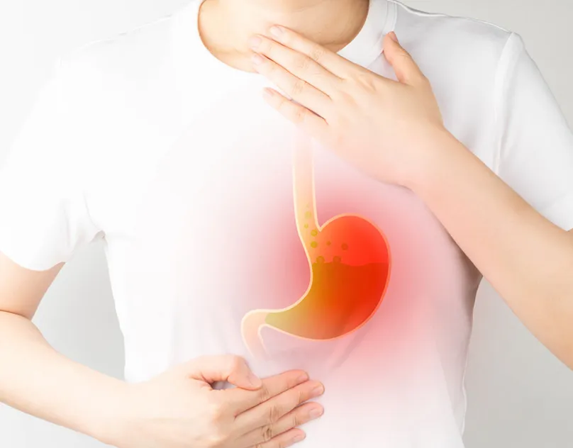 Acid reflux after gastric sleeve gastrectomy