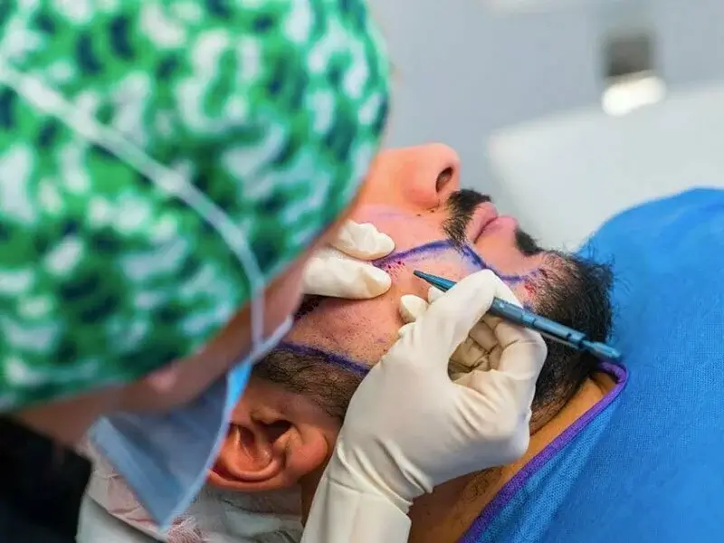 Beard Grafting