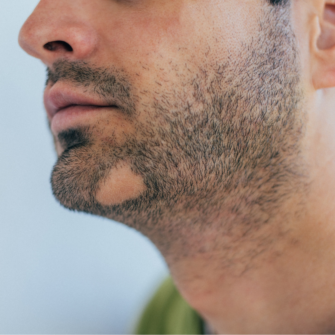 beard transplant results