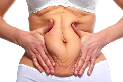 Bloating after bariatric surgery