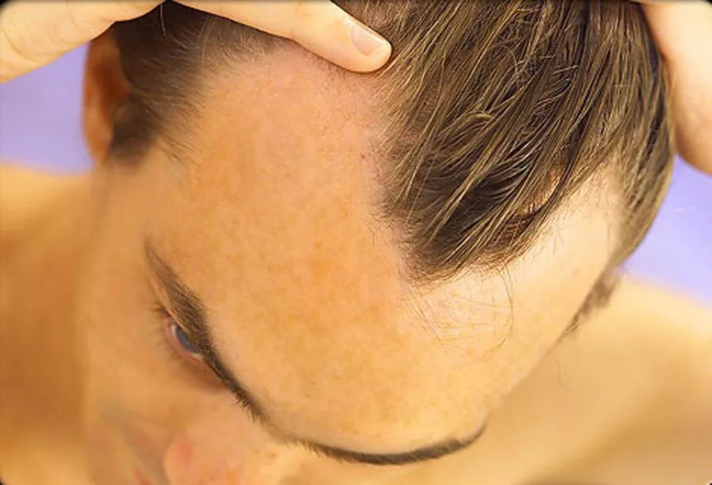 Do Steroids Cause Hair Loss?