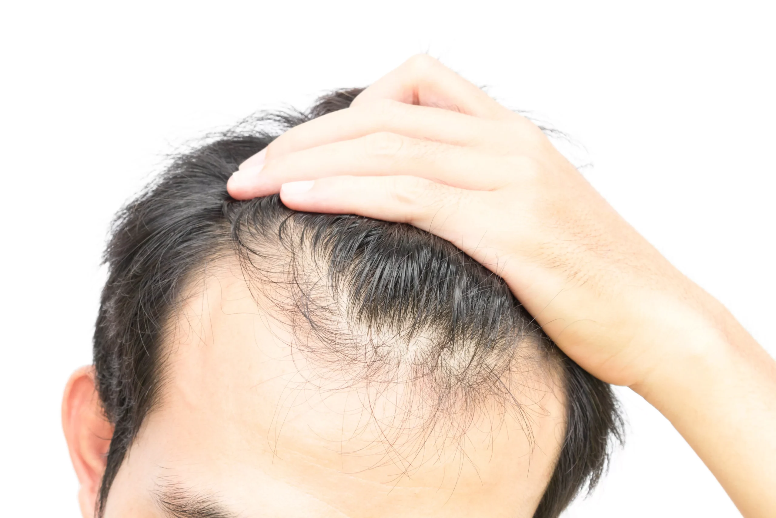 We'll explore male hair loss, the causes and symptoms of male pattern hair loss, and the steps you can take to manage the early stages.