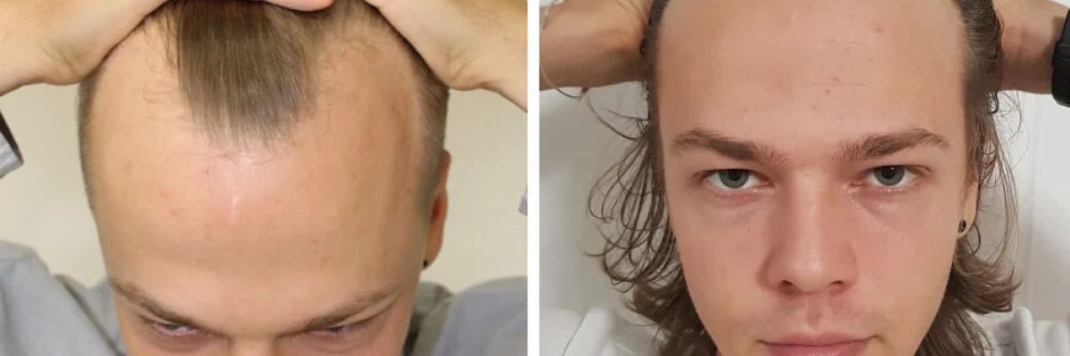 2 Weeks After FUE Hair Transplant
