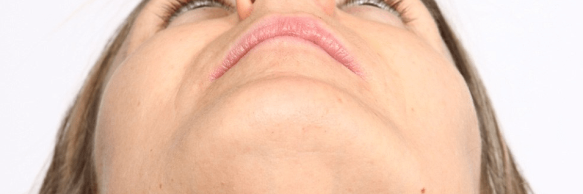 Deviated Septum Surgery in Turkey