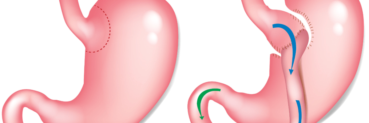 Weight Loss Surgery Abroad - Gastric Sleeve & Bypass