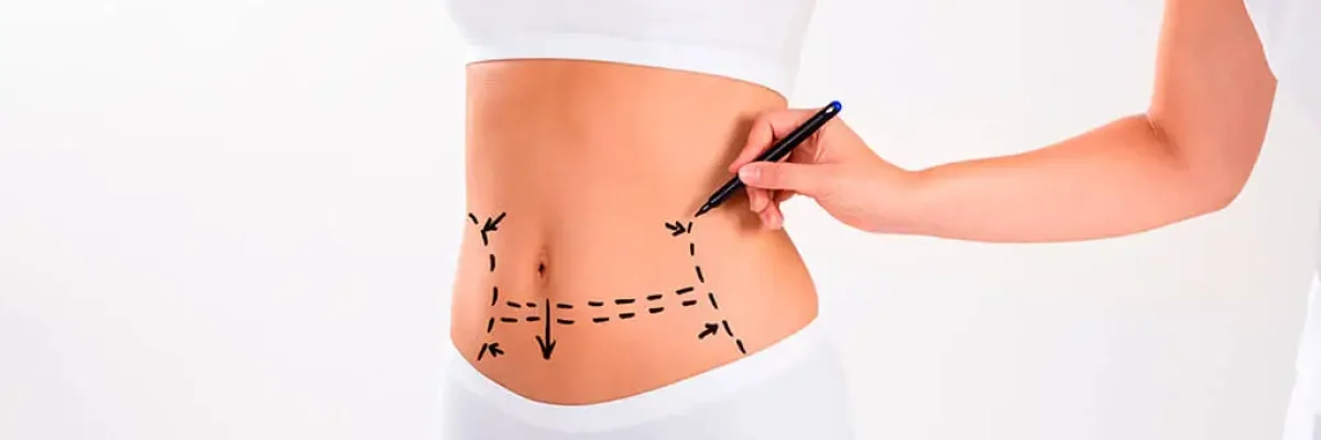 What is mini tummy tuck surgery?