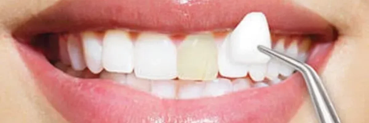 dental-veneers