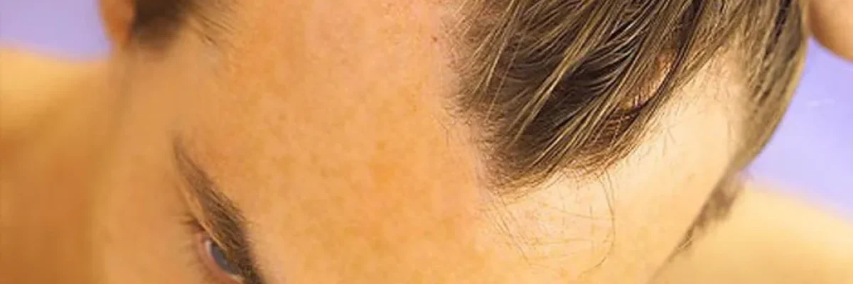 Do Steroids Cause Hair Loss?