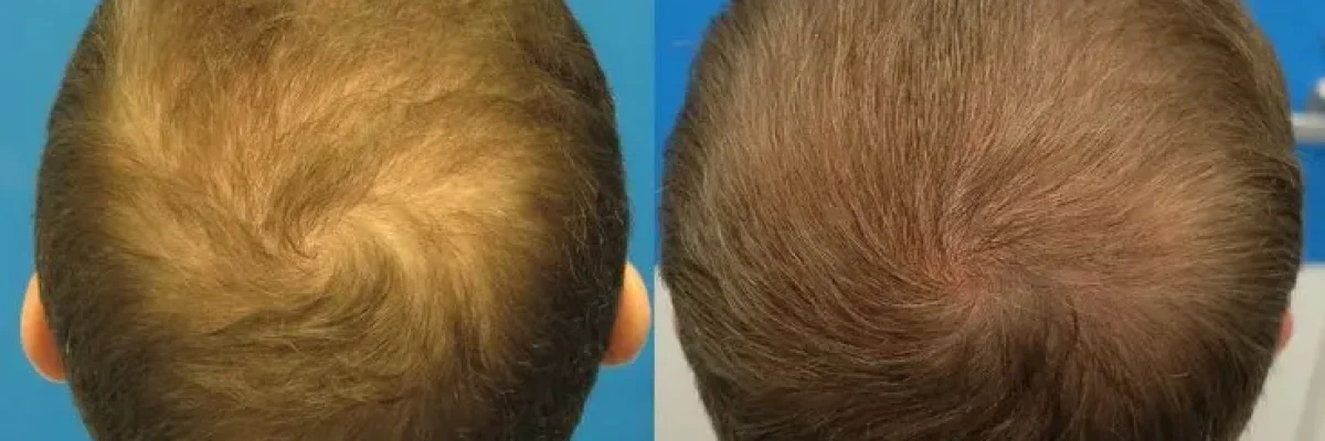 Hair Graft Before and After