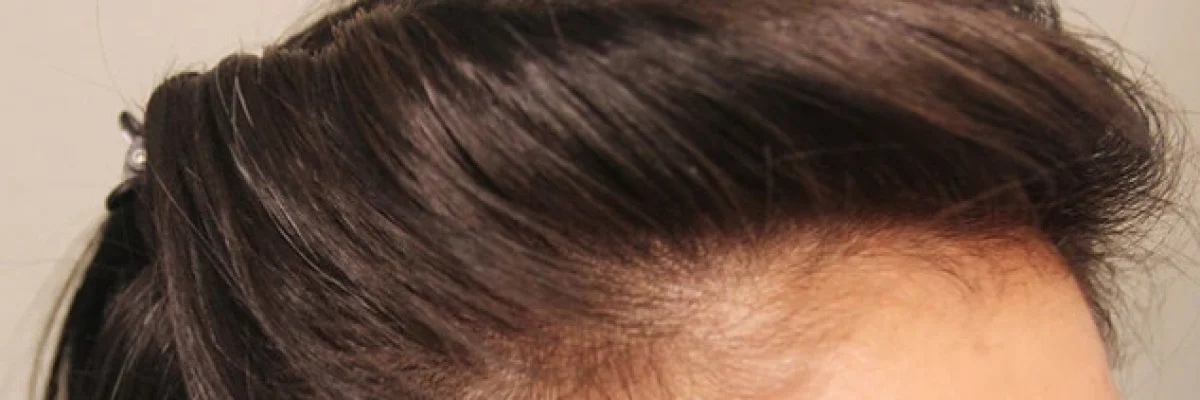 Hair Systems: Change Your Appearance with Hair Transplant