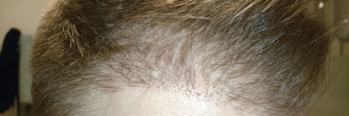 Hair transplant timeline
