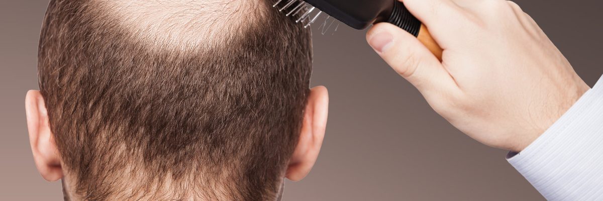 Hair transplantation for less decreased hair