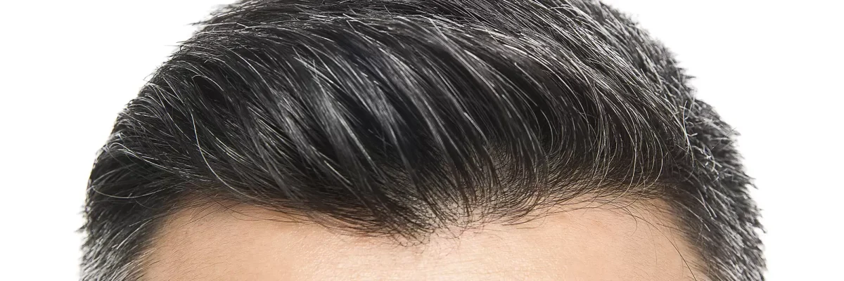Hairline surgery, also known as hairline lowering surgery, is a cosmetic procedure that has gained significant attention in recent years.