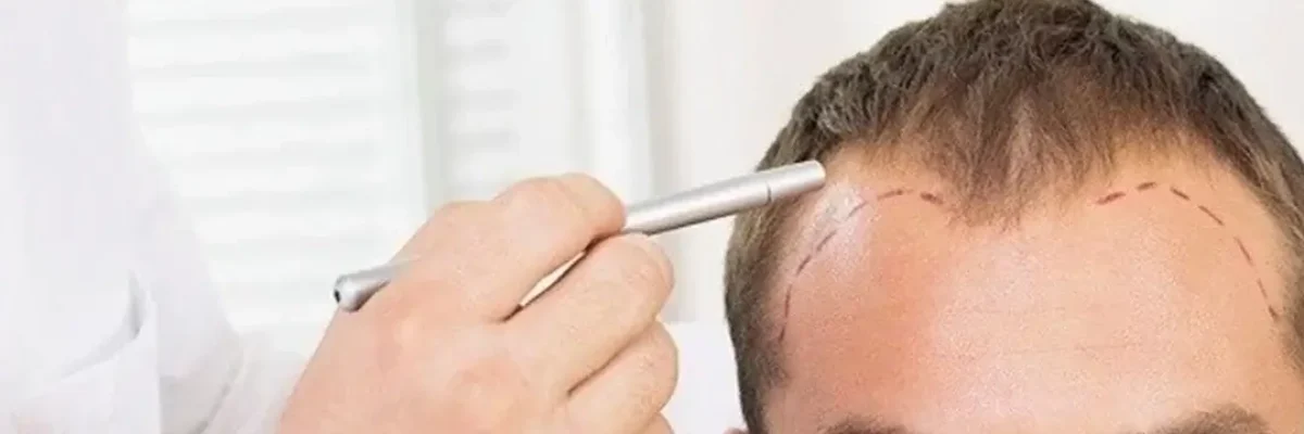 micro-hair-transplant