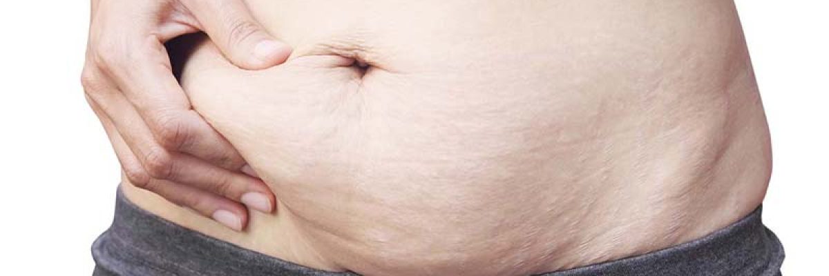 It's crucial to remember that every woman's body is unique, and the degree of loose skin after pregnancy can vary greatly.