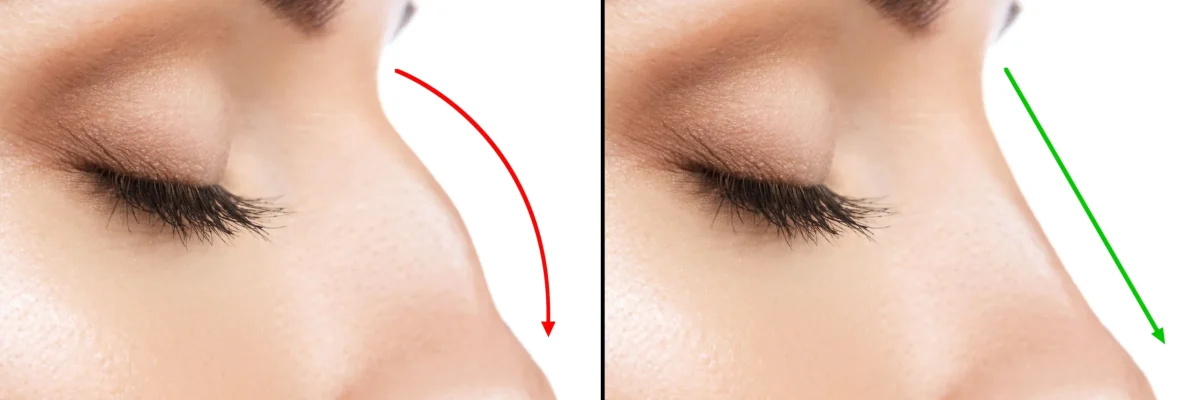 rhinoplasty lifespan