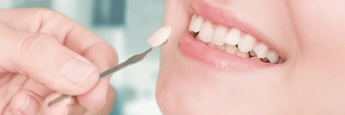 veneers-min-2
