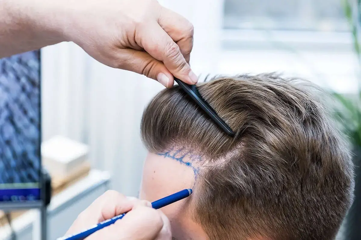 exosomen-haartransplantation (1)
