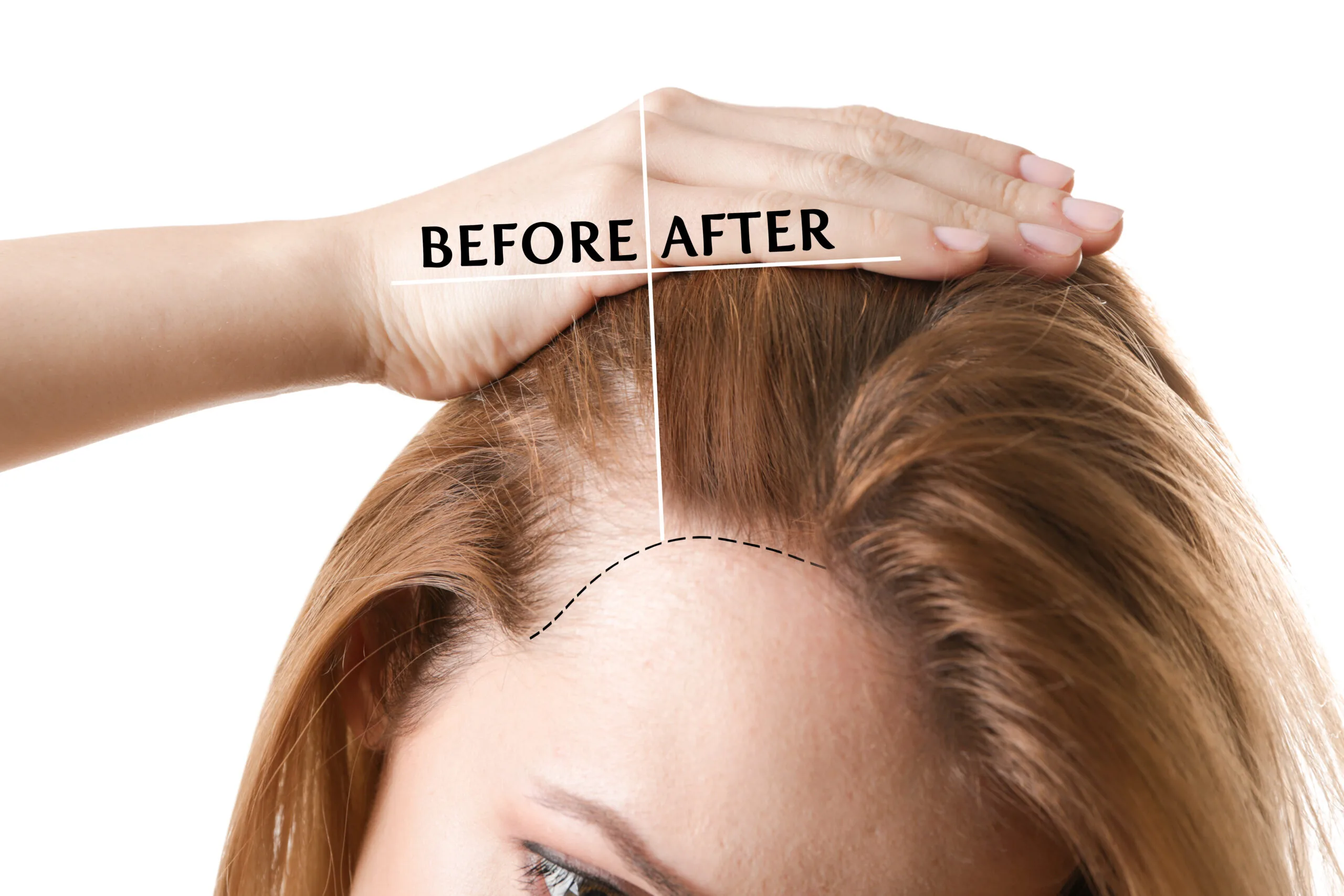 Female hair transplant 