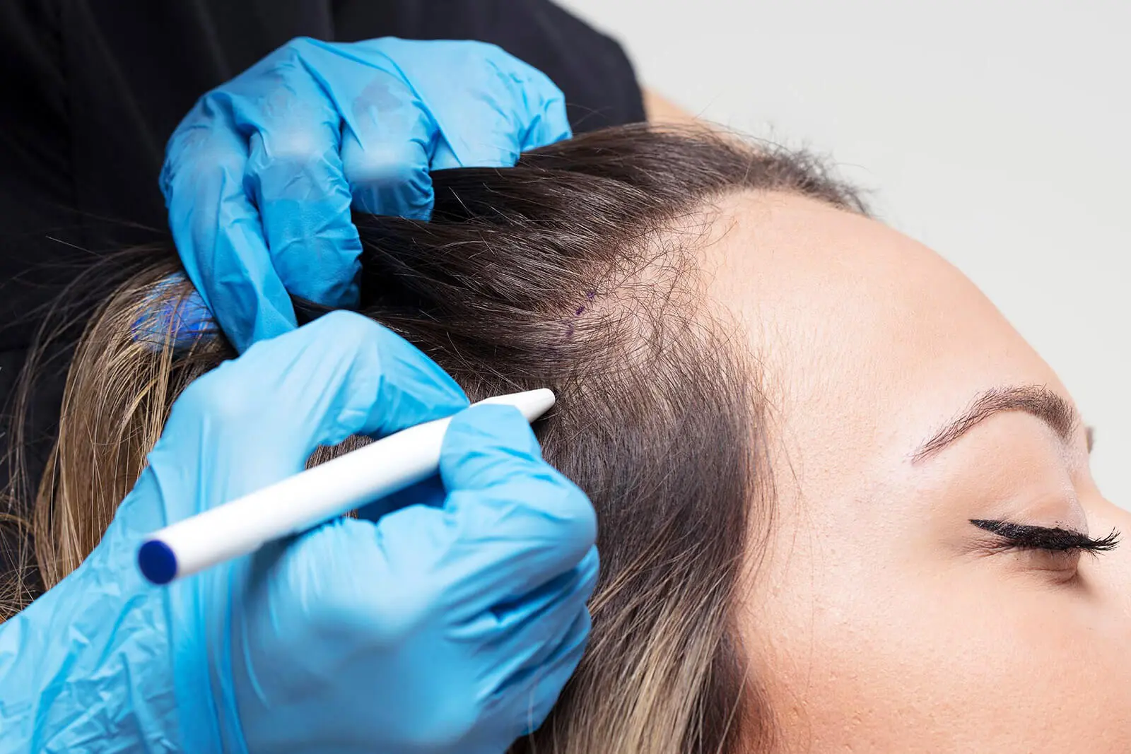 Female hair transplant