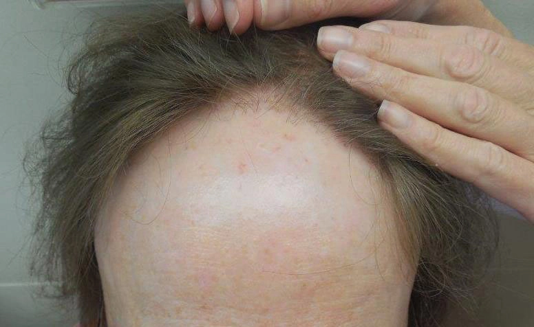 Frontal Fibrosing Alopecia: Causes, Symptoms, and Treatment