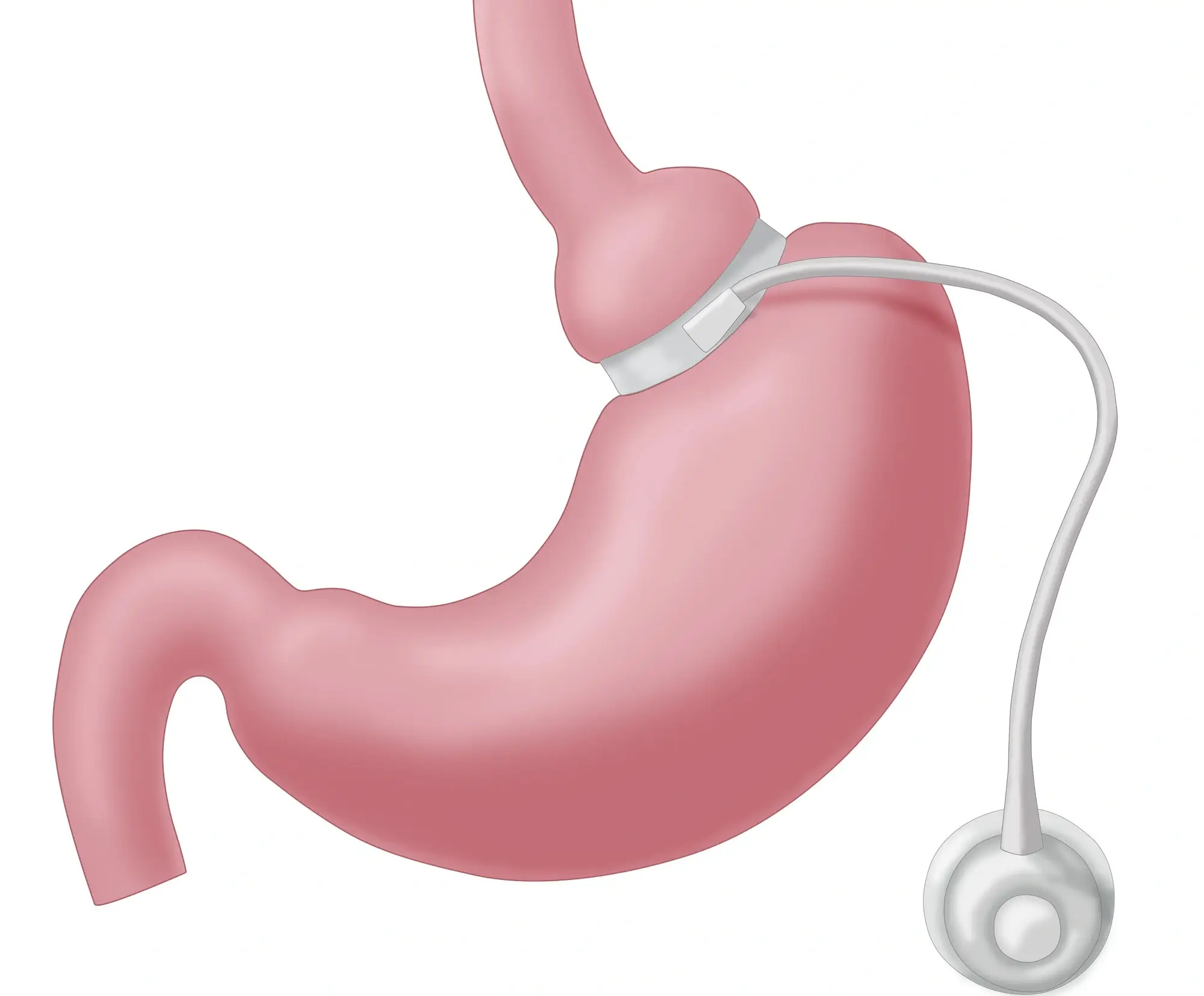 Gastric sleeve vs gastric band