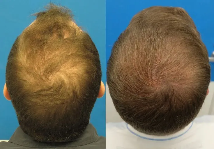 Hair Graft Before and After