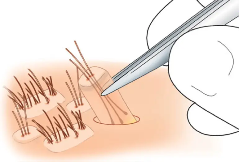 Hair Graft
