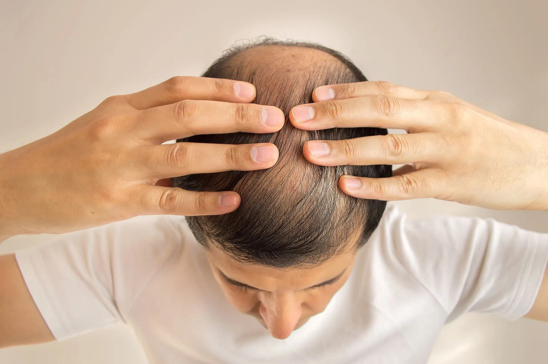 Hair Regrowth for Men