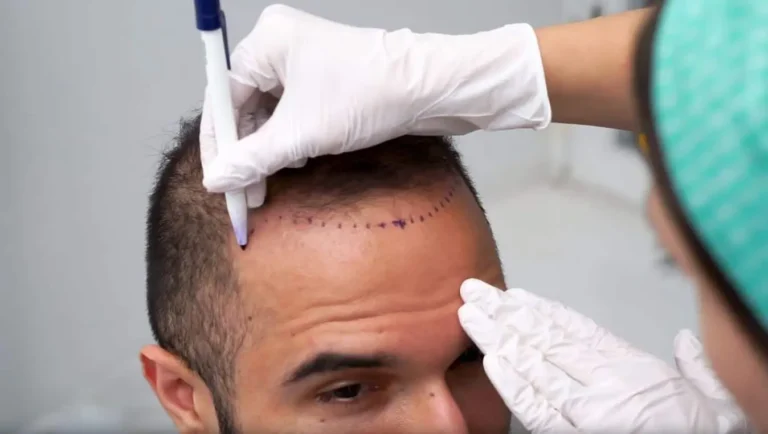 Hair transplant expenses