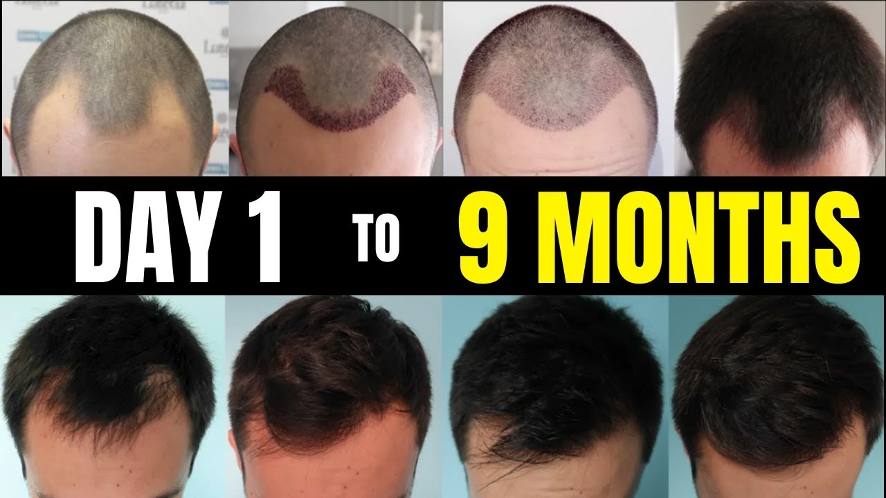 Hair transplant timeline