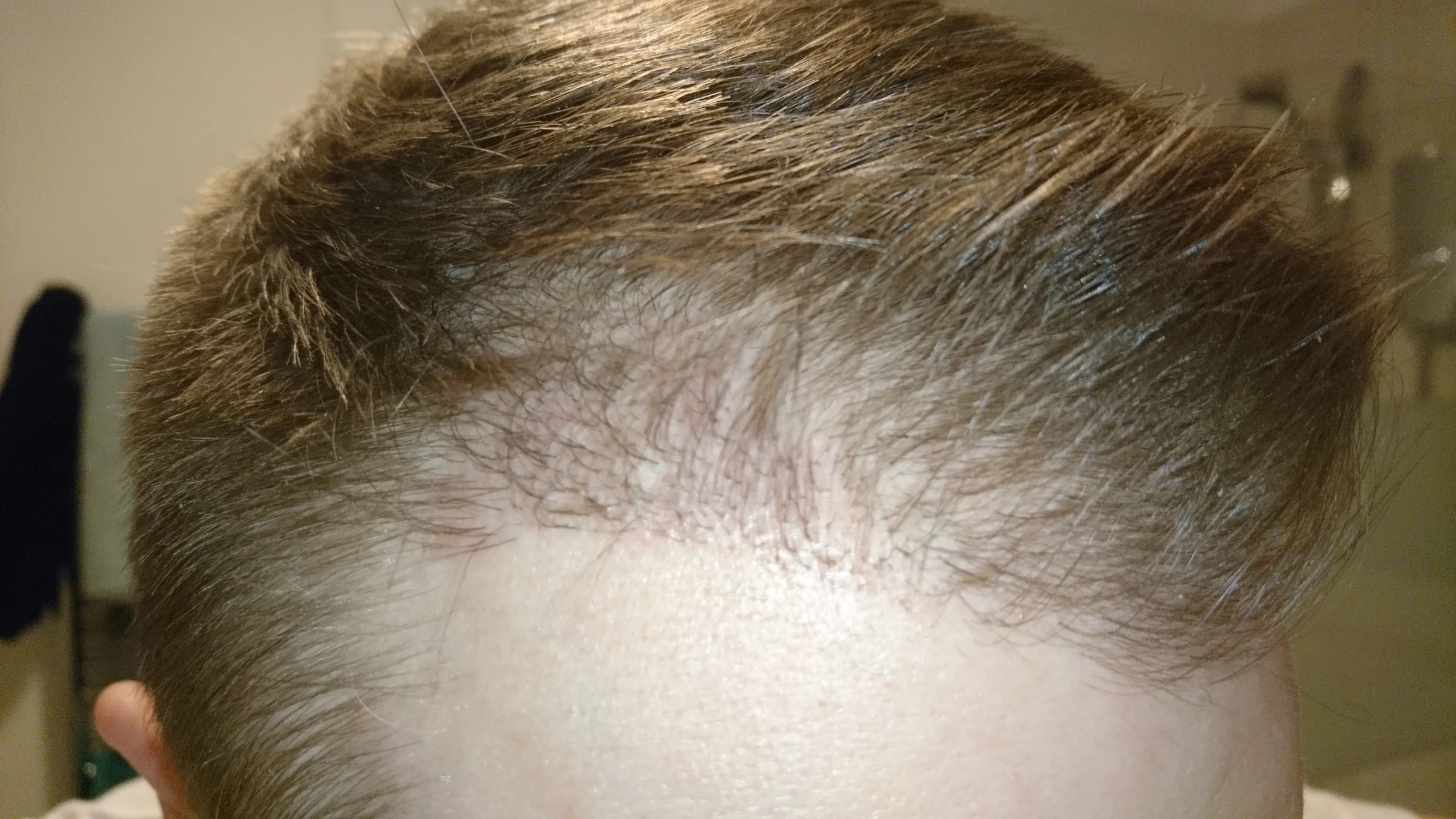 Hair transplant timeline