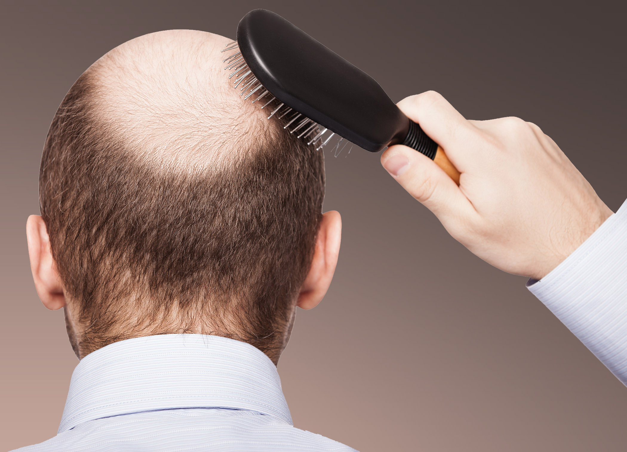 Hair transplantation for less decreased hair
