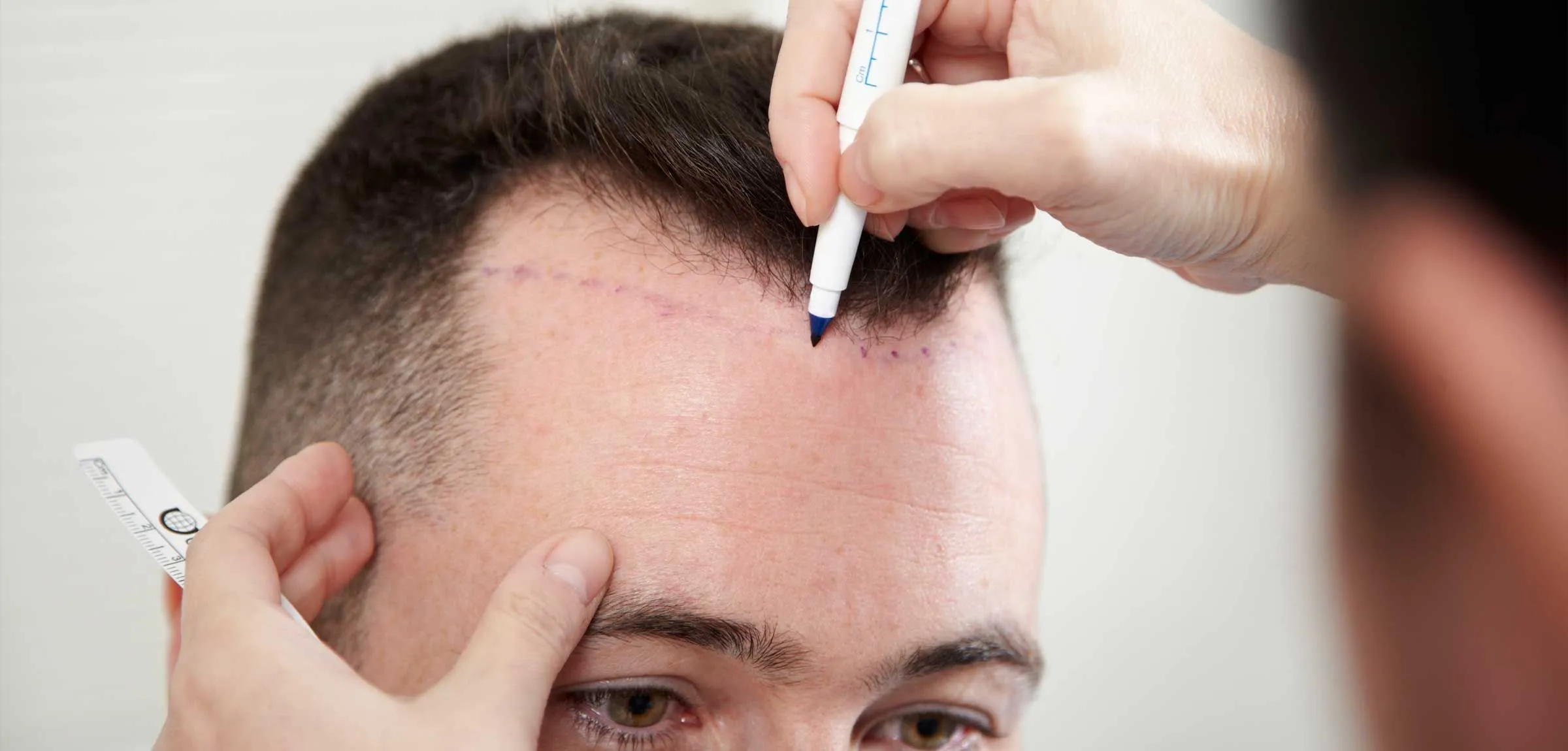 Hairline Surgery UK: Everything You Need to Know