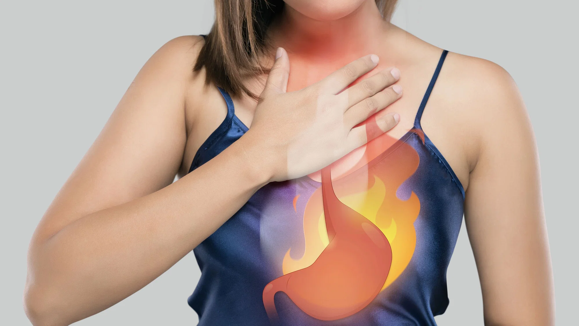 Heartburn after Gastric Sleeve Surgery
