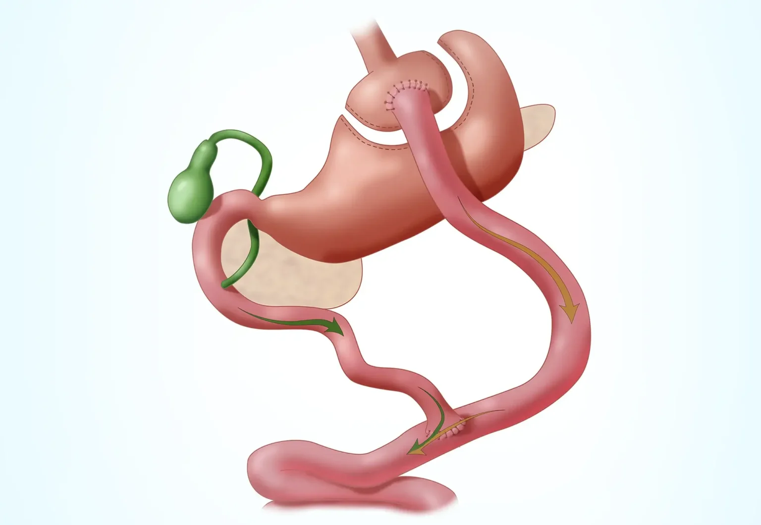 Reviews of Gastric Bypass in Turkey