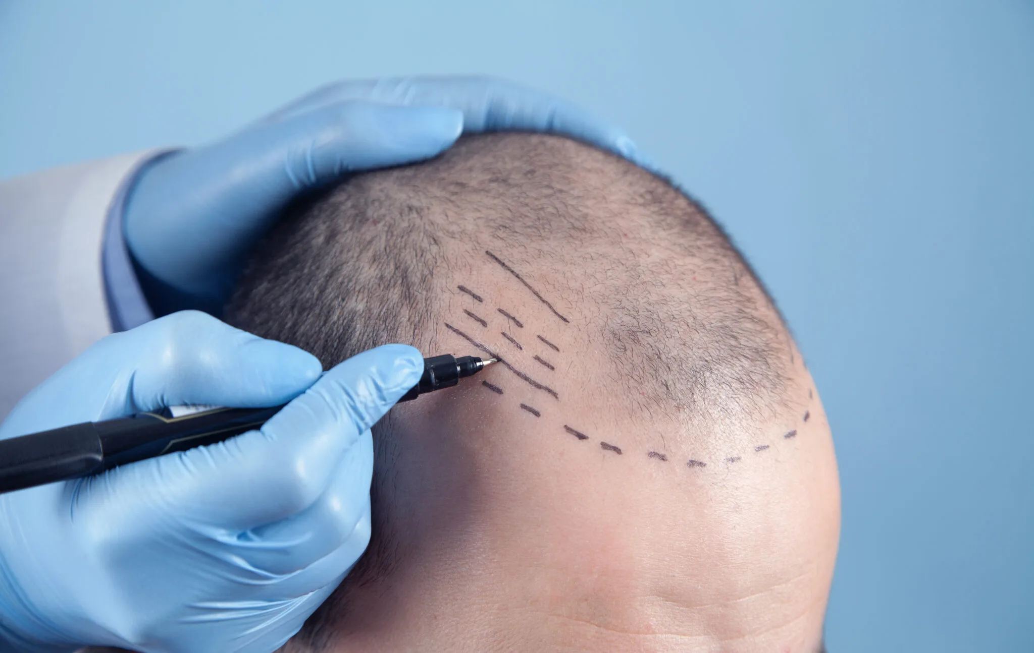 Manual FUE hair transplant