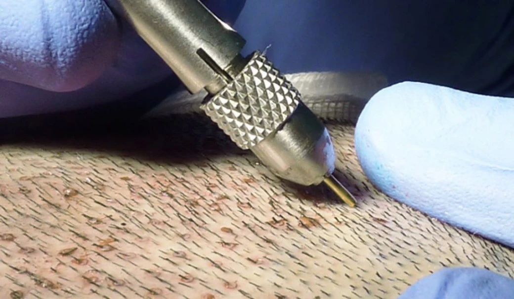 Manual FUE hair transplant