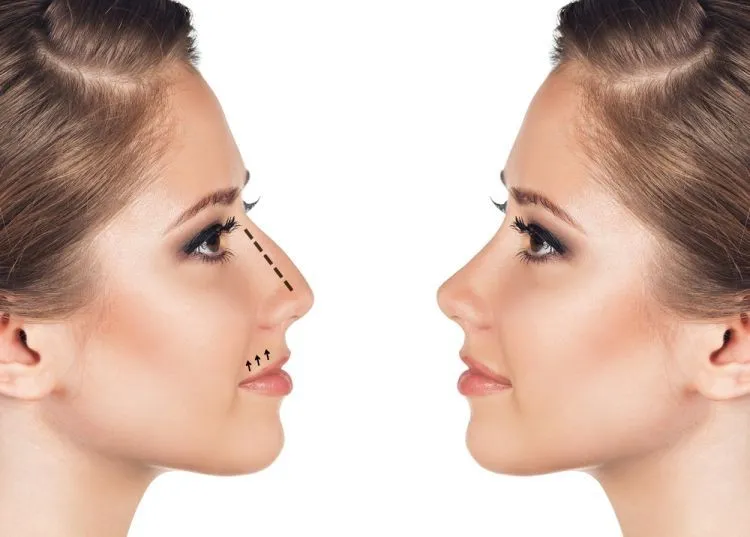 Non-Surgical Nose Job