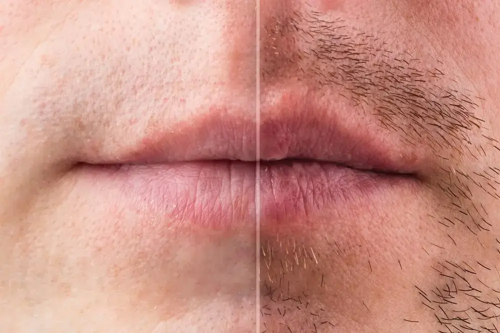 que-es-un-trasplante-de-barba-1