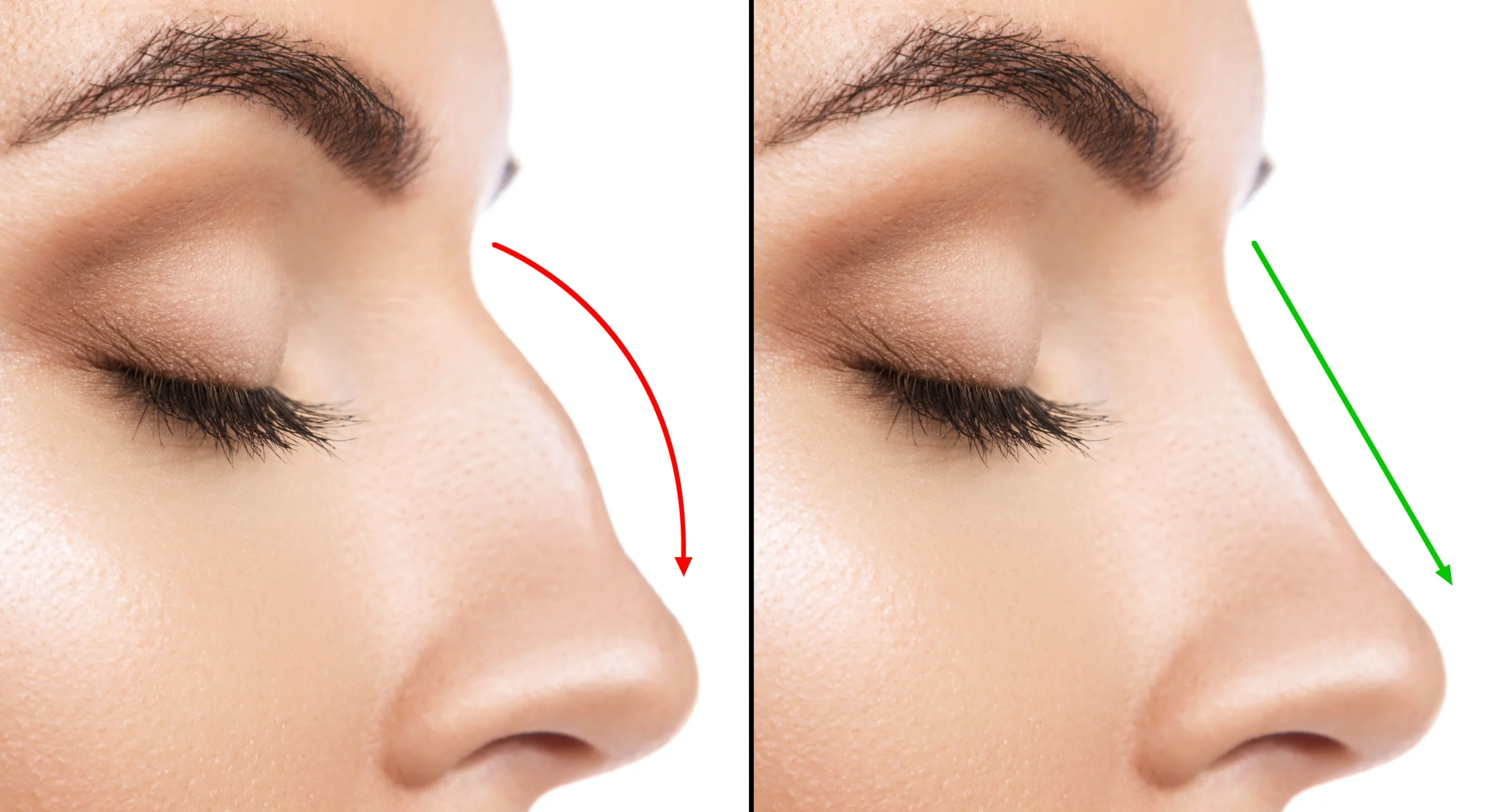 rhinoplasty lifespan