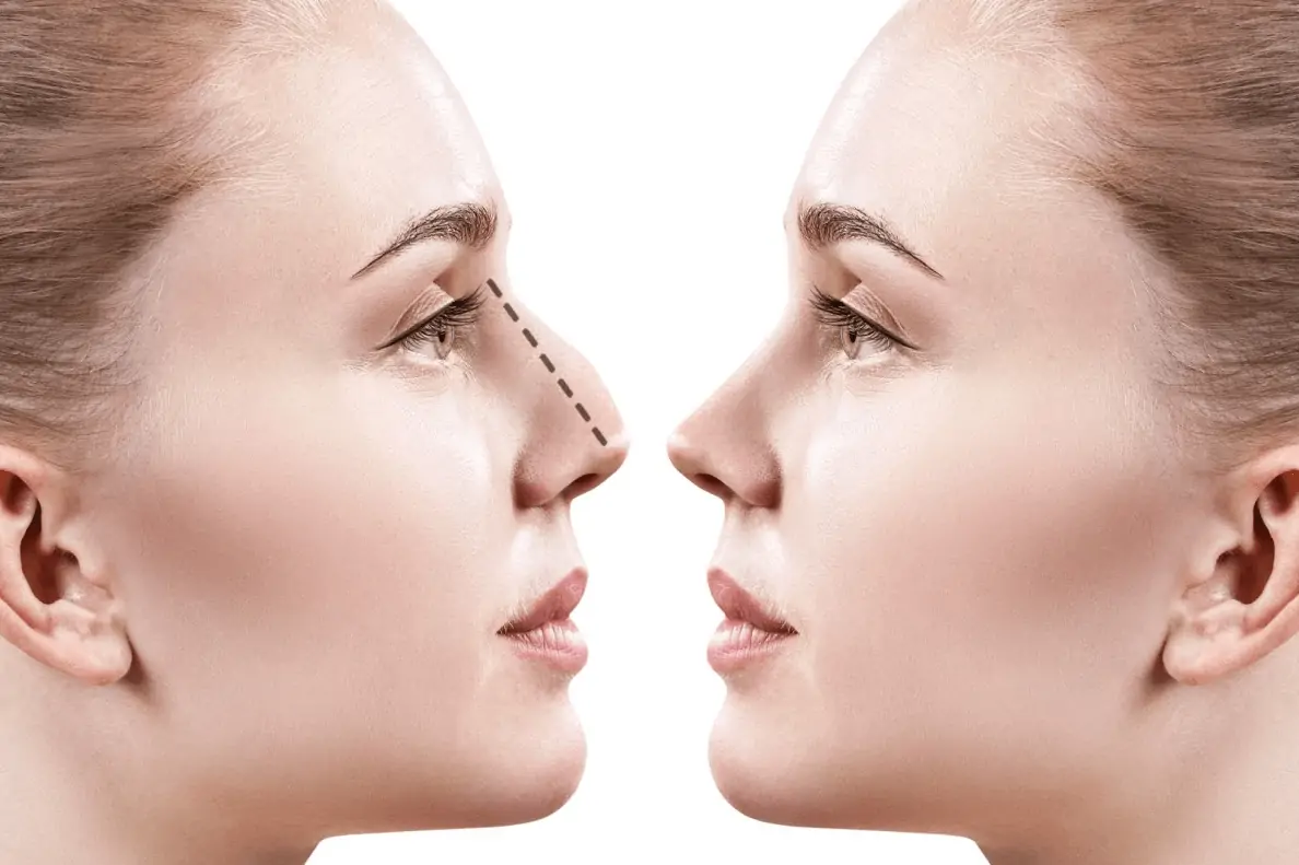 types of rhinoplasty